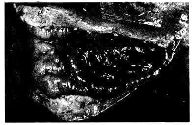 Hipertrofia pilórica Hipertrofia pilórica