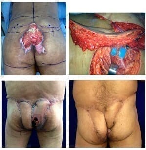 Colgajos en hélice de las arterias perforantes, Defecto preoperatorio