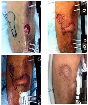 Colgajos en hélice de las arterias perforantes, Defecto preoperatorio