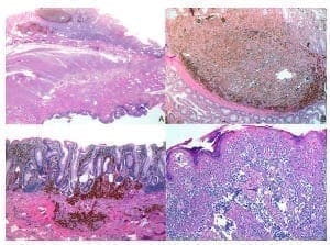 Células pigmentadas atípicas con crecimiento intramucoso Células pigmentadas atípicas con crecimiento intramucoso