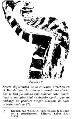 Deformidad de la columna vertebral