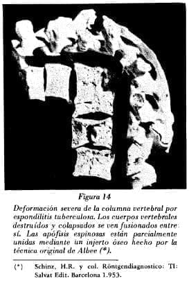Deformación de la columna vertebral  Deformación de la columna vertebral