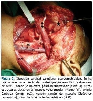 Disección cervical ganglionar supraomohioidea Disección cervical ganglionar supraomohioidea