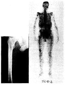 Estudio esquelético negativo para metástasis Estudio esquelético negativo para metástasis