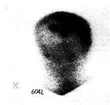 Concentración anormal del trazador en hueso del cráneo Concentración anormal del trazador en hueso del cráneo