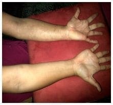 Macrodactilia en segundo y tercer dedos de mano