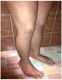 Deformidad de los dedos y várices MM II
