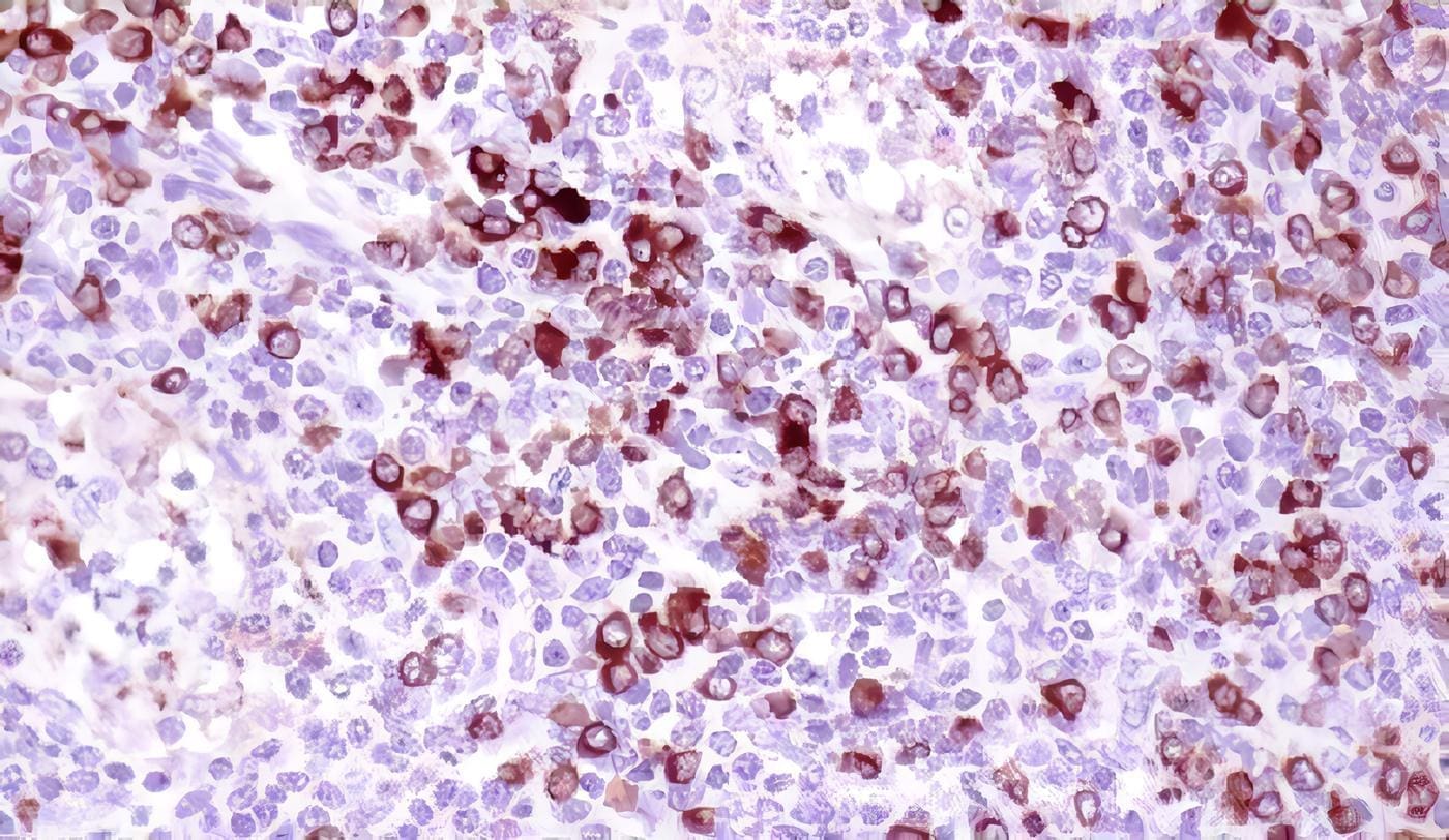 Linfoma Anaplásico de célula grande