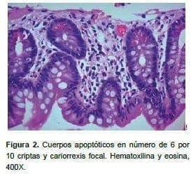 Cariorrexis focal Cariorrexis focal