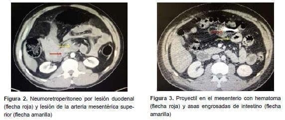 Neumoretroperitoneo por lesión duodenal Neumoretroperitoneo por lesión duodenal