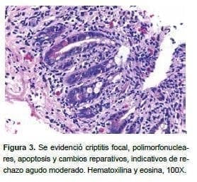 Criptitis focal Criptitis focal