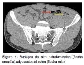 Burbujas de aire extraluminales