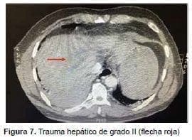 Trauma hepático de grado II