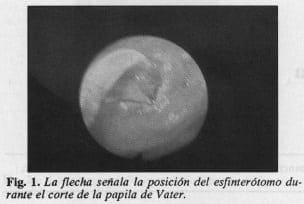 Corte de la papila de Vater