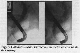 Coledocolitiasis
