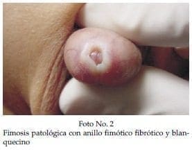 Fimosis patológica con anillo fimótico fibrótico y blanquecino Fimosis patológica con anillo fimótico fibrótico y blanquecino