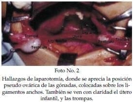 Posición pseudo ovárica de las gónadas