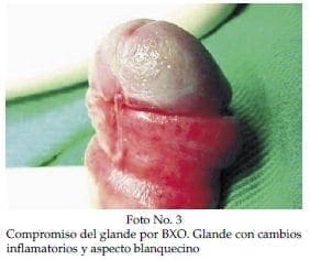 Compromiso del glande por BXO Compromiso del glande por BXO