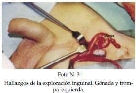 Hallazgos de la exploración inguinal