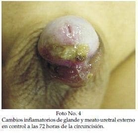 Cambios inflamatorios de glande y meato uretral Cambios inflamatorios de glande y meato uretral