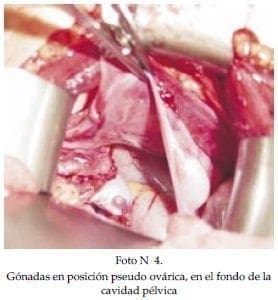 Gónadas en posición pseudo ovárica