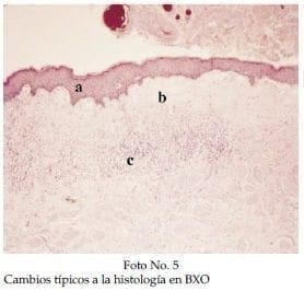 Cambios típicos a la histología en BXO Cambios típicos a la histología en BXO