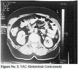 Abdominal Contrastado