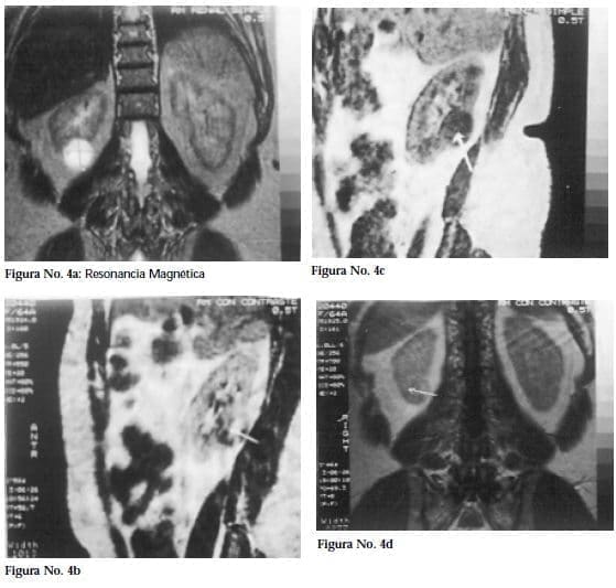 Nefroma Quístico Multilocular, Resonancia Magnética Nefroma Quístico Multilocular, Resonancia Magnética