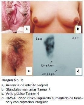 Vaginoplastia