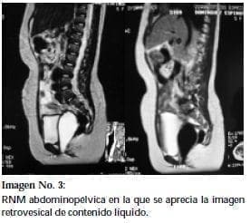 RNM abdominopélvica RNM abdominopélvica