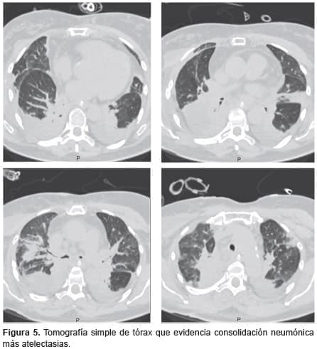 Reconstrucción tráqueal, consolidación neumónica más atelectasias
