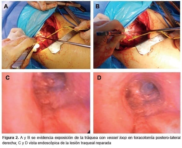 Reconstrucción tráqueal, tráquea con vessel loop