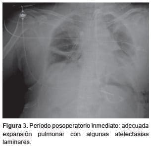 Reconstrucción tráqueal con algunas atelectasias laminares