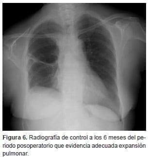 Reconstrucción tráqueal, expansión pulmonar