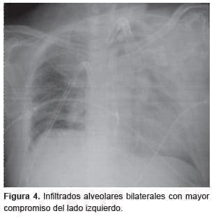 Reconstrucción tráqueal, Infiltrados alveolares bilaterales