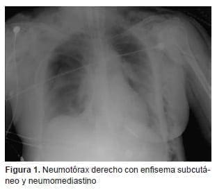 Reconstrucción tráqueal, enfisema subcutá­neo y neumomediastino