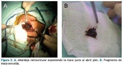 Abordaje retrouricular exponiendo la masa Abordaje retrouricular exponiendo la masa