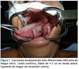 Carcinoma escamocelular