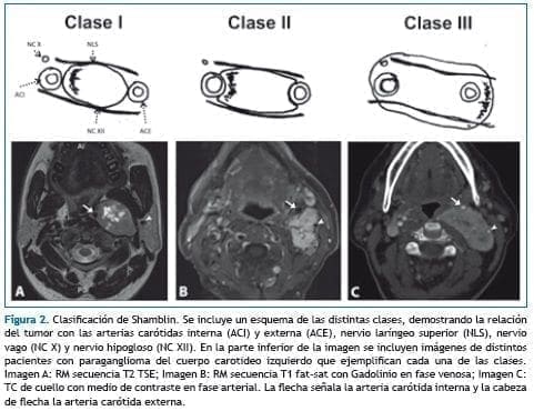 Clasificación de Shamblin Clasificación de Shamblin