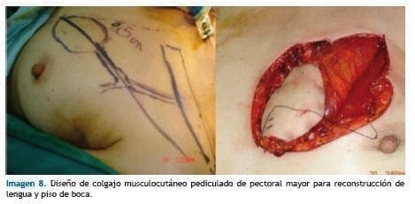 Diseño de colgajo musculocutáneo Diseño de colgajo musculocutáneo