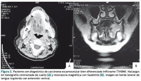 Diagnóstico de carcinoma escamocelular Diagnóstico de carcinoma escamocelular