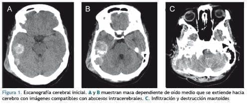 Escanografía cerebral inicial Escanografía cerebral inicial