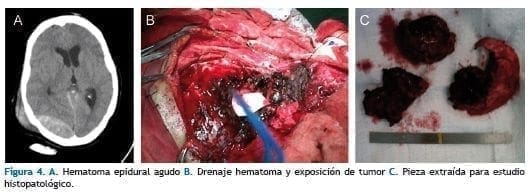 Hematoma epidural agudo Hematoma epidural agudo