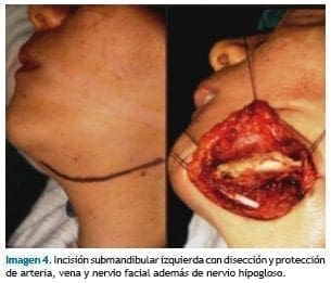 Incisión submandibular Incisión submandibular