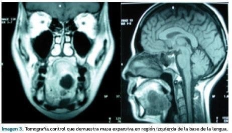 Tomografía de base de la lengua Tomografía de base de la lengua