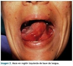 Masa en región izquierda de base de lengua Masa en región izquierda de base de lengua