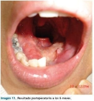 Resultado postoperatorio de injerto mandibular Resultado postoperatorio de injerto mandibular