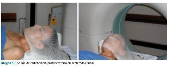 Sesión de radioterapia Sesión de radioterapia