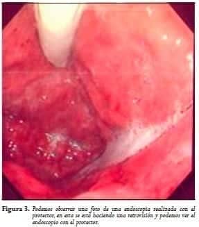Endoscopio con el protector  Endoscopio con el protector