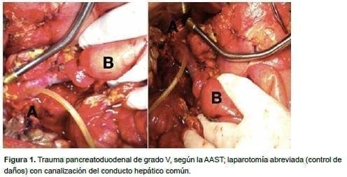 Trauma pancreatoduodenal